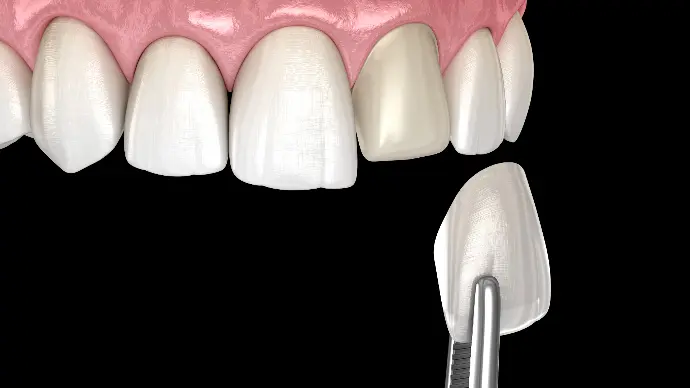 Estetica dentale e faccette nello studio dentistico